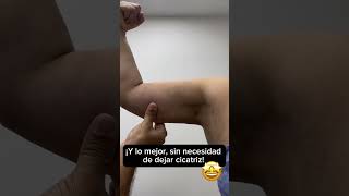 BRAQUIOPLASTIA SIN CICATRIZ ¿Brazo de Tia ¿Alas de Murcielago ¿Grasa en los Brazos Dr John Garcia [upl. by Ojela]