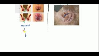 Hemorrhoids Lecture for USMLE [upl. by Riay]