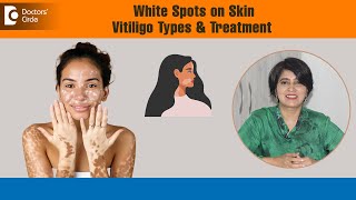 Vitiligo on full body or one sideSegmental vs Non Segmental VitiligoDrRasya DixitDoctors Circle [upl. by Vasily]