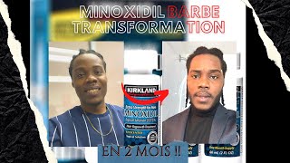 AVOIR UNE BARBE EN SEULEMENT 2 MOIS MINOXIDIL 5 RÉSULTAT [upl. by Aihseyk]