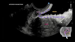 Dynamic transvaginal ultrasound examination for assessing anatomy of parametrium UOGJournal [upl. by Aneala]