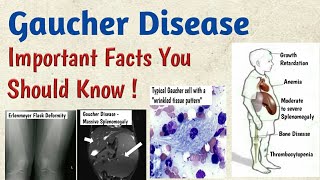 Gaucher Disease Symptoms Causes Types Complications Diagnosis amp Treatment [upl. by Voltz]