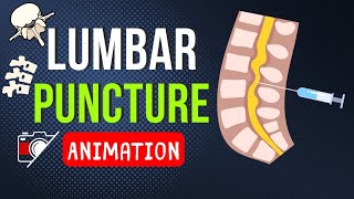 🎬 LUMBAR PUNCTURE LP  SPINAL TAP  TECHNIQUE  ANATOMY  SAMPLE  ANIMATION [upl. by Adrian]