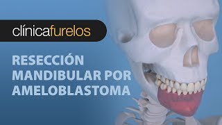 Resección mandibular por ameloblastoma 01 [upl. by Sanalda318]