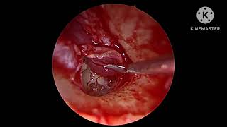 Endoscopic Excision of Fisch type A Right Glomus tympanicum Dr Babu AR JSSAHER Mysuru India [upl. by Nnayhs384]