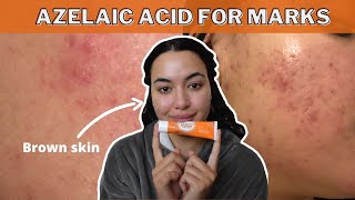 HOW TO FADE POST INFLAMMATORY HYPERPIGMENTATIONERYTHEMA WITH AZELAIC ACID SKINOREN 20 cream [upl. by Tonya]