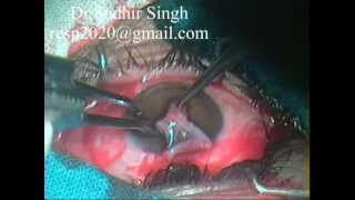 Conjunctival Graft Harvesting For Pterygium Excision With Autograft By Dr Sudhir Singh 32 [upl. by Raquel]