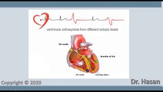 Extrasystole  Premature contraction  atrial nodal and ventricular extrasystole [upl. by Ajnin382]