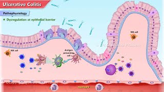 Ulcerative Colitis Animation  Etiology Clinical features Pathophysiology Diagnosis Treatment [upl. by Nicolas]