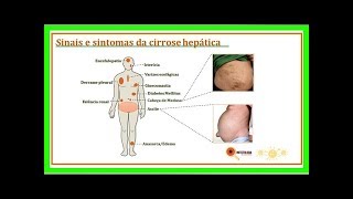 Sintomas de cirrose hepática [upl. by Icak]