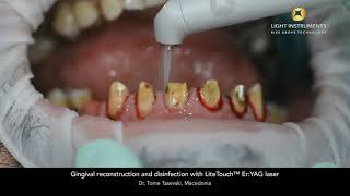 Gingival reconstruction and disinfection with LiteTouch™ ErYAG laser [upl. by Luahs]