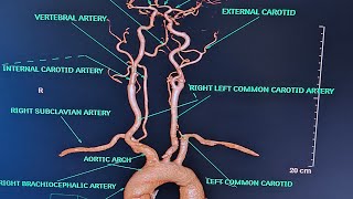 BRAIN AND NECK ANGIOGRAPHY On ct scanALL ABOUT ANGIOGRAPHYPART2CONCEPT ON ANGIOGRAPHY [upl. by Kampmann]