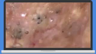 Punti Neri Acne blackheads Removal pt3 [upl. by Lumbard]