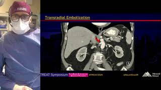 Transradial Selective Renal Artery Embolization for Renal Cell Carcinoma Prior to Ablation [upl. by Griffith]