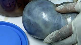 Big Size – Ovarian Cyst Benign Serous Cystadenoma Dissection essenceworld [upl. by Nalod]