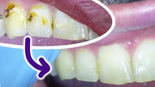 🦷 Fixing A Cavity On A Front Tooth With A White Filling Including Brown amp Black Decay Between Teeth [upl. by Pelletier]