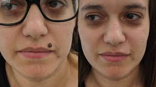 Facial mole removal demo  large mole removed from upper lip  fast and pain free [upl. by Aigil]