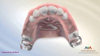 Orthodontic Space Management  Nance Appliance [upl. by Kared]