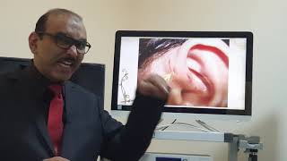 Preauricular sinus Malayalam Patient teaching programme [upl. by Lebbie]