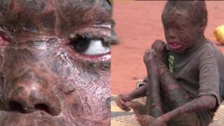 Kenyan Children Suffer from Skin Disease with no cure [upl. by Ahsineg]