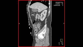 Metastatic Melanoma with Intussusception [upl. by Fendig34]