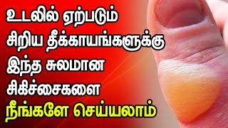 Some Best and Effective Home Remedies for Minor Burns [upl. by Ytrebil787]