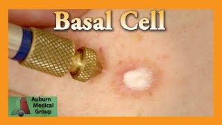 Basal Cell Cryotherapy Treatment  Auburn Medical Group [upl. by Rene]