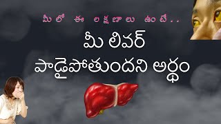 Liver symptoms Telugu కామెర్లు – వాటి లక్షణాలు Jaundice symptoms  Kamerlu  jaundice lakshanalu [upl. by Bird]