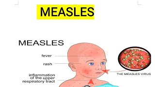 MEASLESखसरा  MSN2 2ND GNM medicalstudent [upl. by Ardnic528]