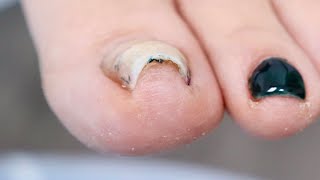 Super CURVED INGROWN Toenail PLUS NAIL REMOVAL [upl. by Firahs212]