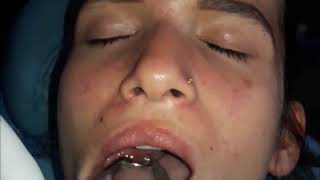 How to remove Tonsil Stones Tonsil Stone Removal Technique [upl. by Jacobo]