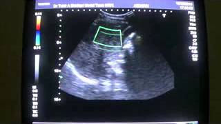 COMPLEX PELVIC MASS in female with FOCAL MASS LESIONS in LIVER [upl. by Rexford395]