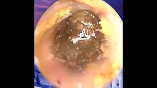 Huge Ear wax removal [upl. by Liva]