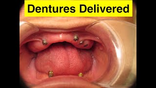 Implant Overdenture Delivered  All on 4 [upl. by Anital]