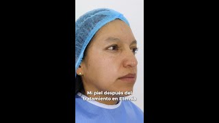 TRATAMIENTO PARA ELIMINAR LAS MANCHAS DEL ROSTRO [upl. by Elrem]