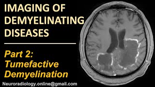 Imaging of Tumefactive Demyelination [upl. by Ihana]