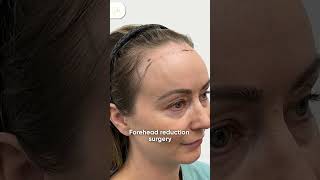 Benefits of forehead reduction surgery  shorts ytshortsindia [upl. by Oakie]