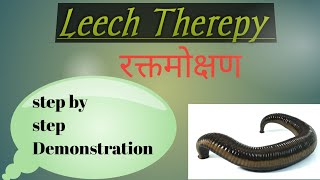 LEECH THERAPY जलौका रक्तमोक्षण क्या होता है इस से [upl. by Meng242]