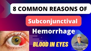 Blood in eyes  Subconjunctival Hemorrhage 8 Reasons and Treatment [upl. by Wetzel]