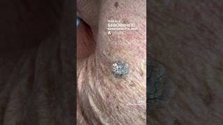 Amazing Wart Removal Results • Before amp After 1 treatment 🤩 [upl. by Francis]