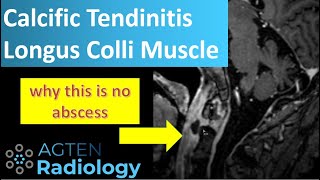 Calcific tendinitis longus colli muscle [upl. by Calie]