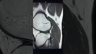 Fabella  Commonly found accessory ossicle [upl. by Schaab989]