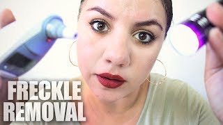 FRECKLE Removal Treatment ASMR [upl. by Ahsinwad]