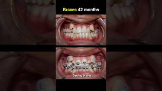 42 months for this braces casr braces orthodontist bracesoff bracesbeforeandafter [upl. by Saphra]