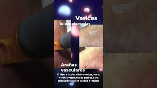 Quitar varices venas y arañas vasculares con láser [upl. by Moretta243]