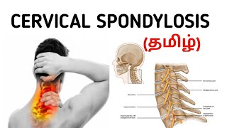 Cervical Spondylosis  Causes  Signs and Symptoms  Risk factor  Treatment  தமிழ் [upl. by Lisan905]