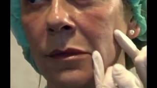 Aumento de pómulos mejillas y recuperación del contorno facial  Tratamiento Facial [upl. by Cirdek]