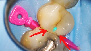 Whats Inside a Massive Cavity Between the Teeth [upl. by Stanislaus]