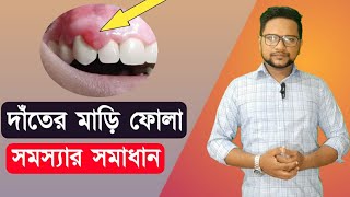 দাঁতের মাড়ি ফুলে গেলে করণীয়। দাঁতের মাড়ি ব্যথা কমানোর উপায়। দাঁতের মাড়ি ফুলে যাওয়া। Dater mari fola [upl. by Annodas]