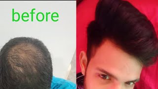 PRP hair treatment  Doha Qatar  reem hospital 🏥 live video 📷 [upl. by Reyem941]